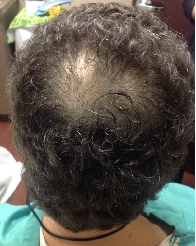 PRP for Hair Loss | Craig Singer MD Dermatology