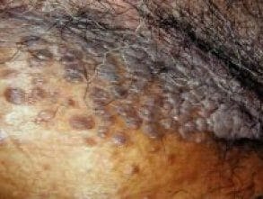 Genital warts (condyloma acuminata) caused by HPV