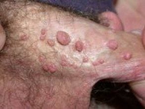 Cauliflower-like genital warts on the skin