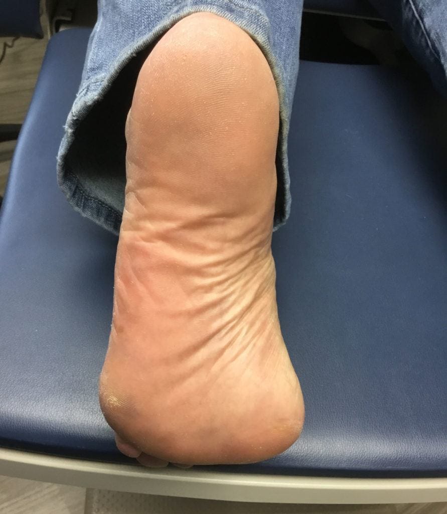 EMA after photo foot psoriasis 1 scaled