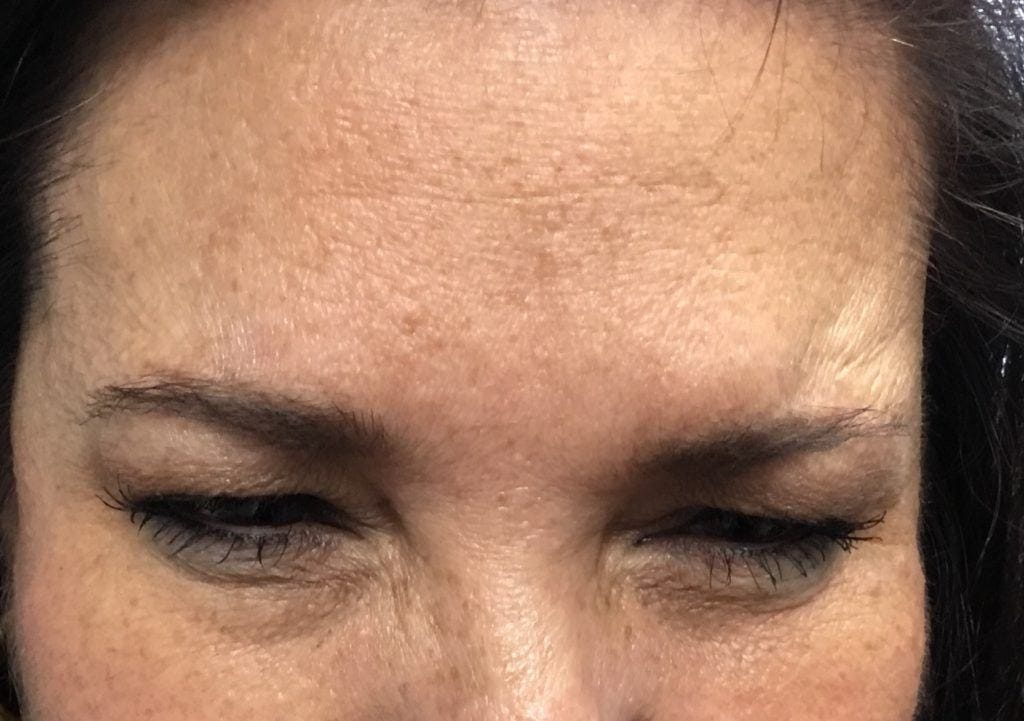 Glabella after Dysport