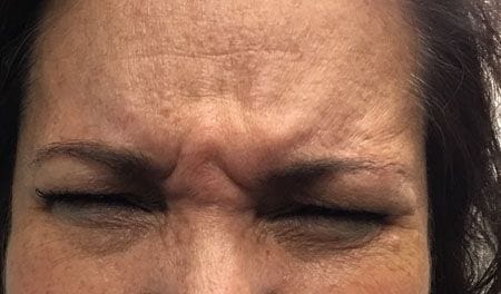 Glabella before Dysport sm