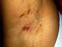 Characteristic boils and abscesses found in the axilla (armpit) of a young woman.