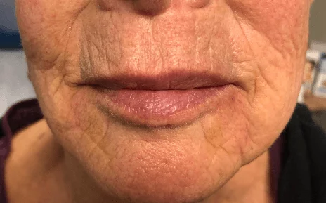 Lips restylane lyft 2