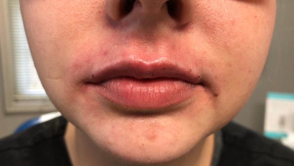 After dermal filler treatment