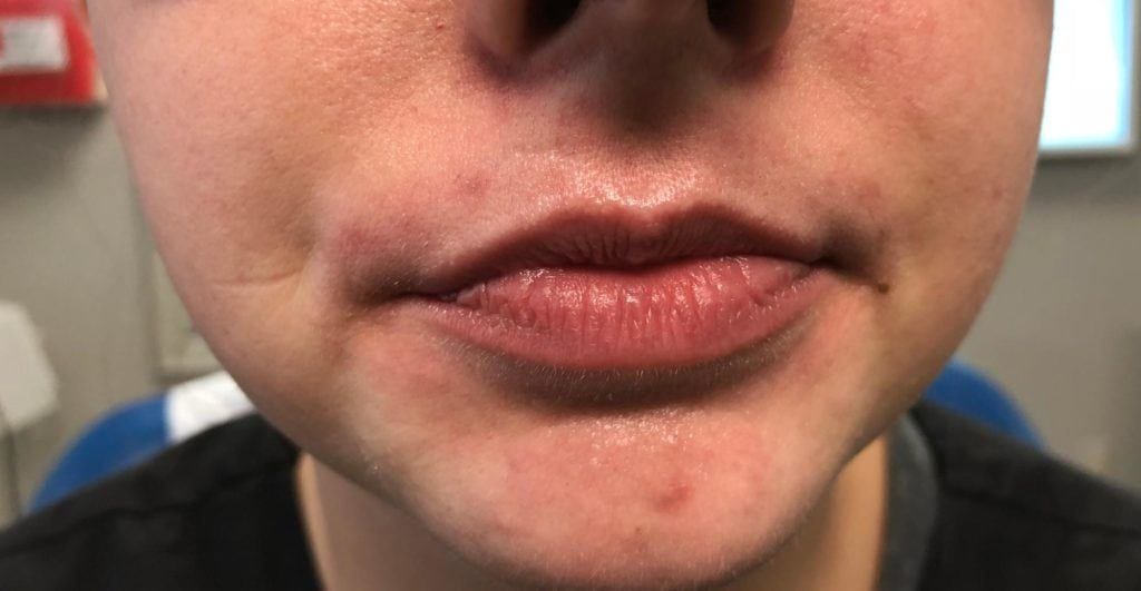 Before dermal filler treatment