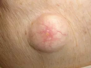 cyst1