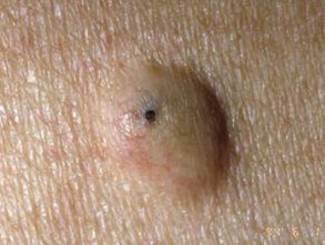 Epidermal inclusion cyst with dilated opening