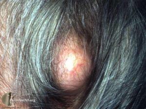 Typical appearence on scalp
