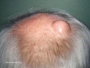 Typical appearence on scalp
