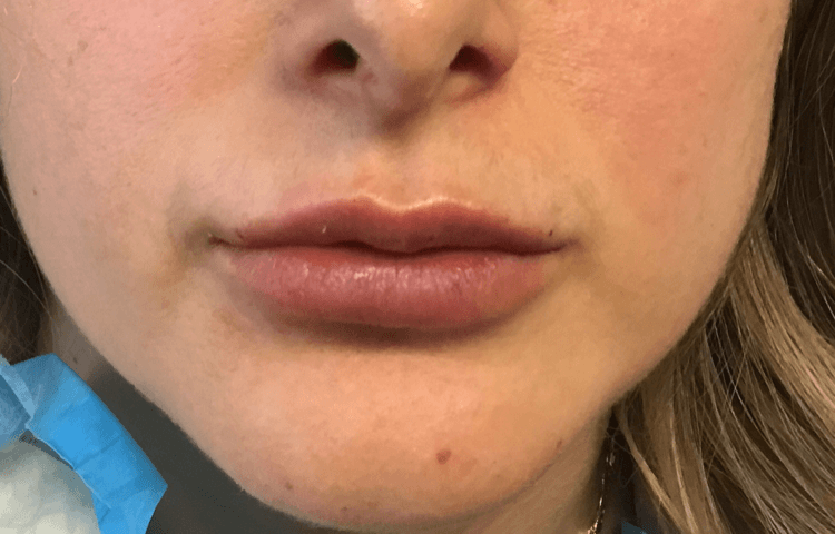 lips botox after