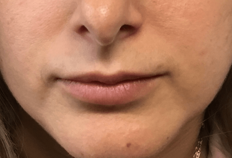 lips botox before