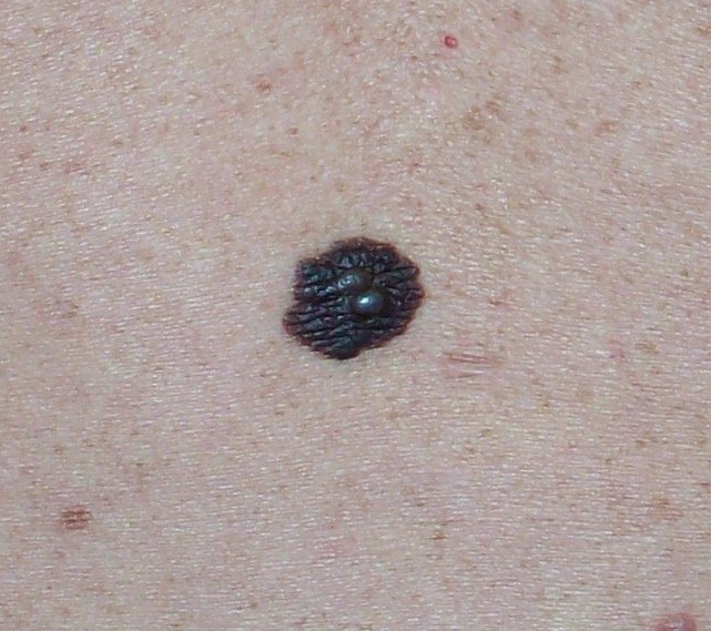 Skin Cancer | Craig Singer MD Dermatology