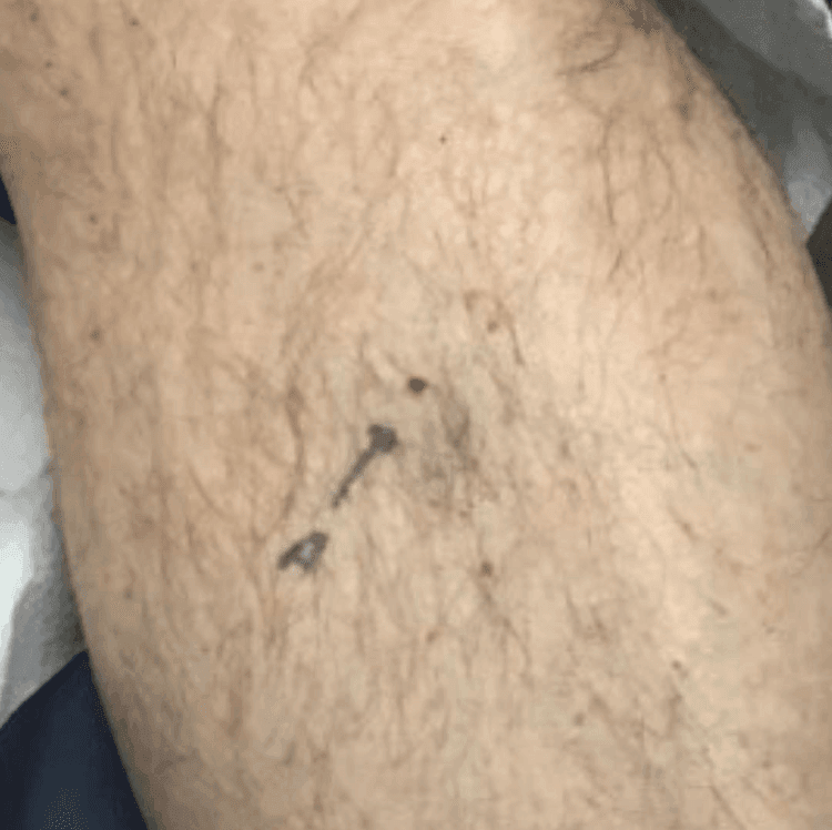 Melanoma diagnosed by Dr. Singer using a dermatoscope