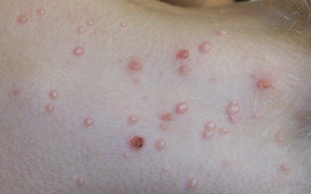 Umbilicated flesh-colored molluscum papules on a child's neck