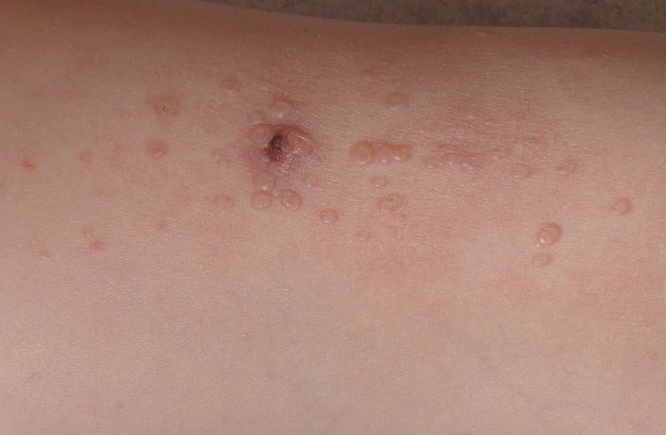 Molluscum papules with surrounding eczema (molluscum dermatitis)