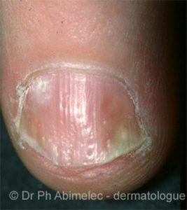Pitting, separation, and oil drop changes of nail psoriasis