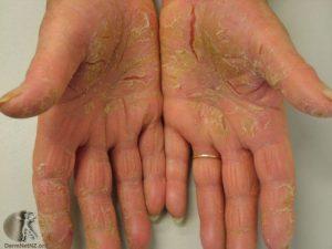 Painful thickened and split palms of hand psoriasis