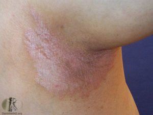 Patches in the armpit seen with “inverse” psoriasis