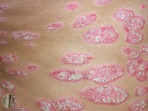 Classic red colored plaques of psoriasis with thick white scales.