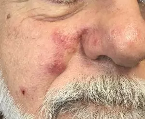 rosacea before 1 e1560024038102