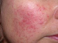 Redness, flushing and red bumps are signs typical of rosacea.Photo courtesy of Dermnetnz.org