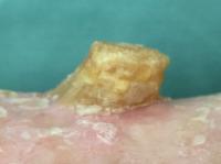 Cutaneous horn with underlying SCC