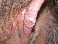 Squamous cell carcinoma (SCC) on the ear