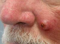 Rapidly growing squamous cell carcinoma (SCC) on the cheek