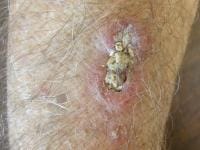 Plaque of squamous cell carcinoma (SCC) on the arm