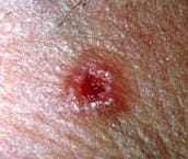 skin cancer Basal Cell  Carcinoma