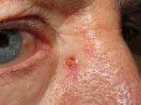 skin cancer basal cell carcinoma near eye