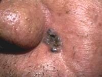 skin cancer pigmented