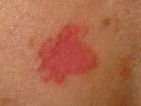 skin cancer superficial  type