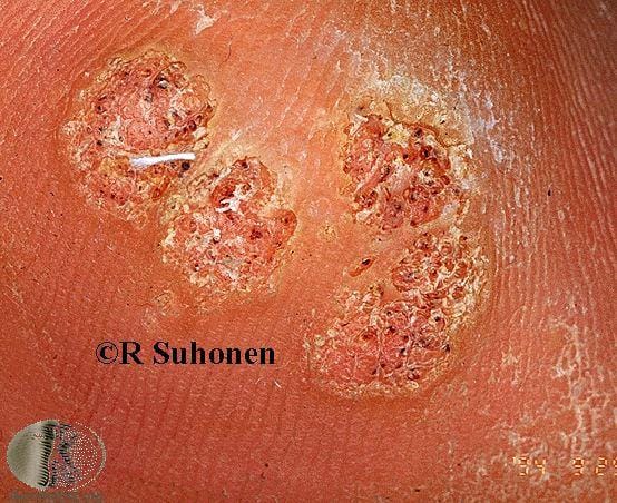 Plantar warts on the foot showing black dots