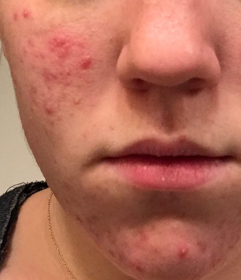 teenage acne face before