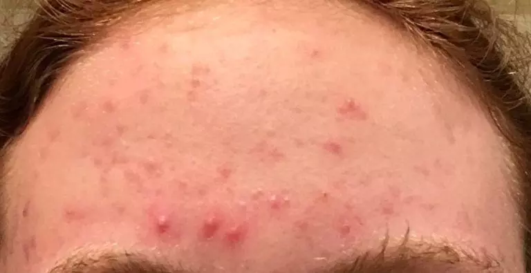 teenage acne forehead before