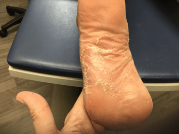 foot psoriasis pretreatment
