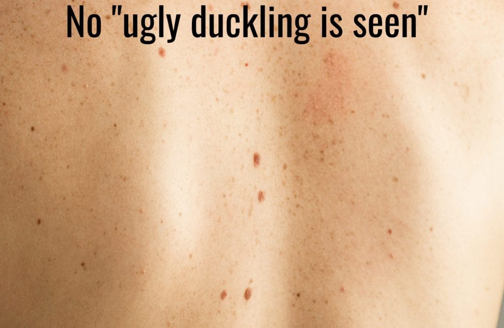 benign moles 2 1 scaled