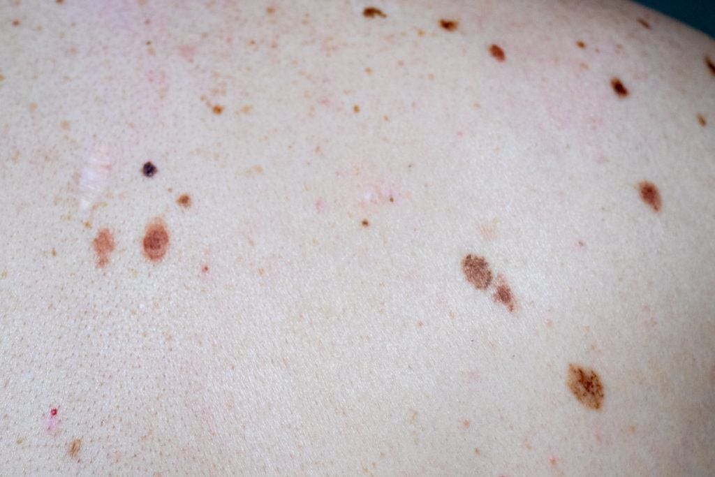 dysplastic moles scaled