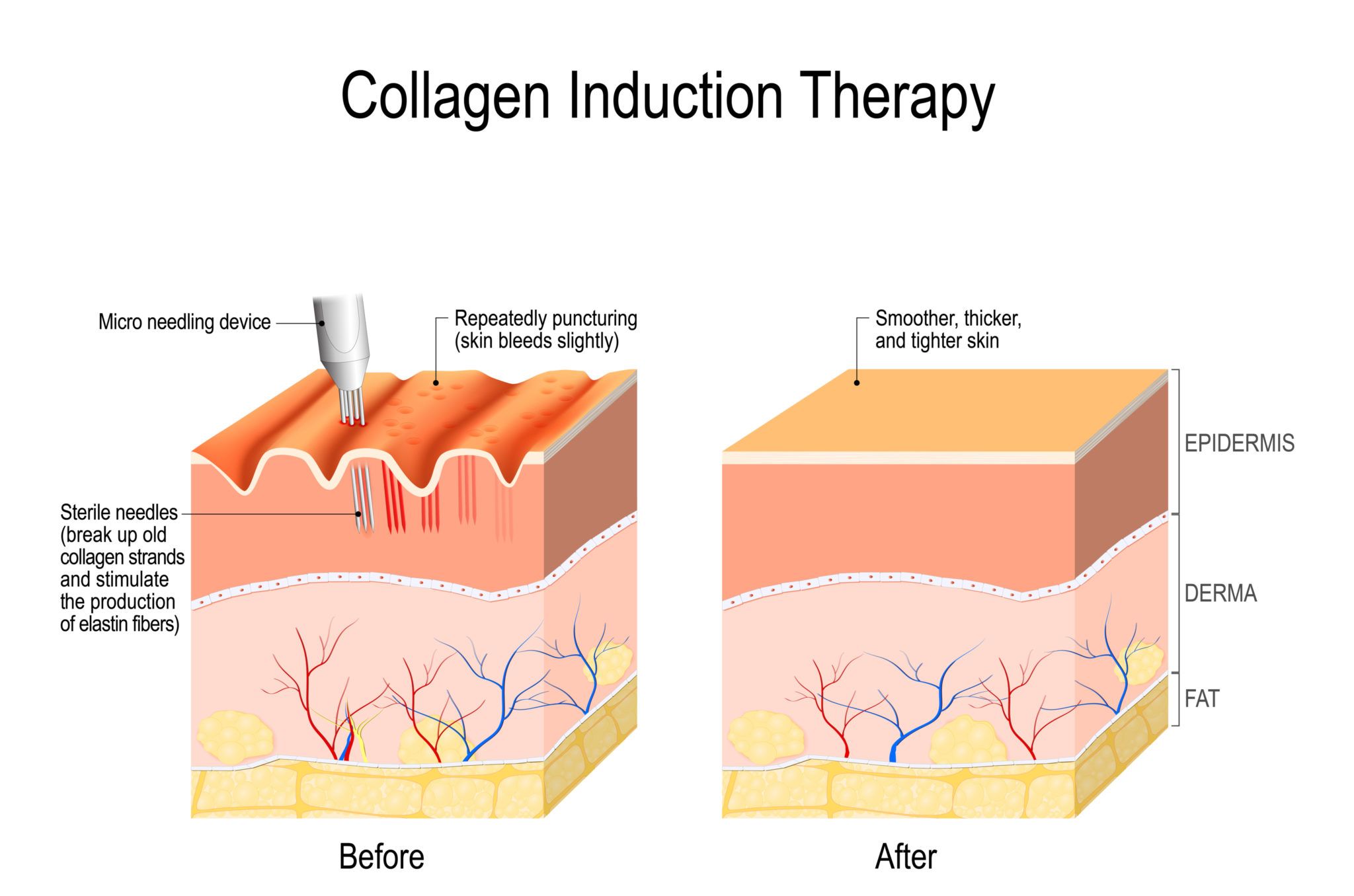 microneedling-craig-singer-md-dermatology