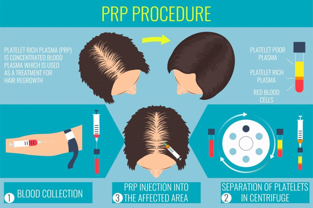 PRP for Hair Loss | Craig Singer MD Dermatology