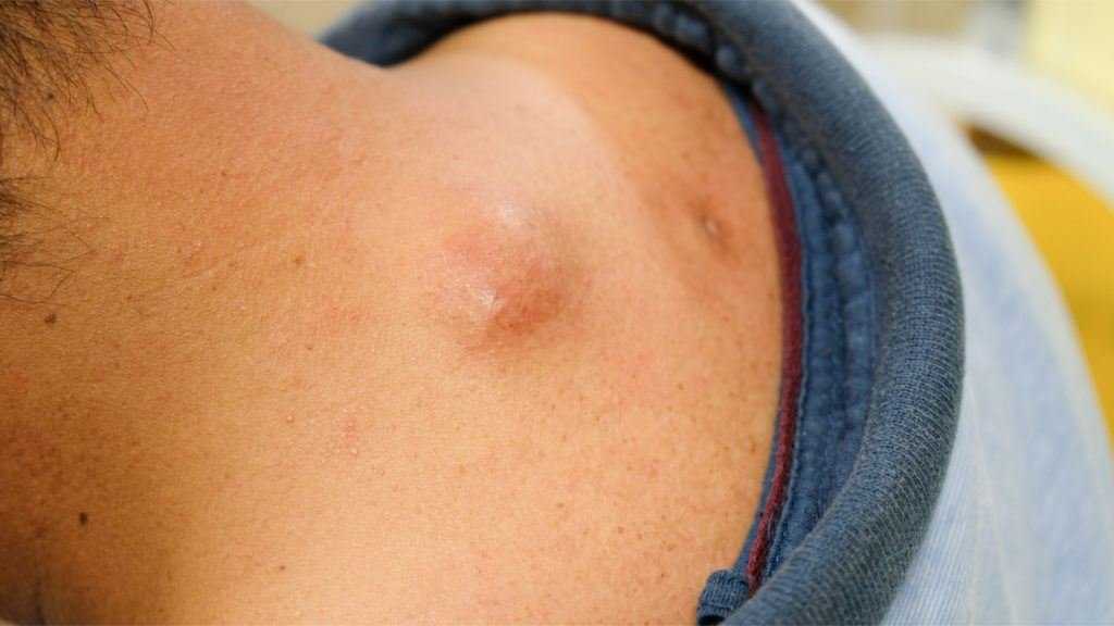 cyst cover photo scaled