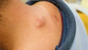 cyst cover photo scaled