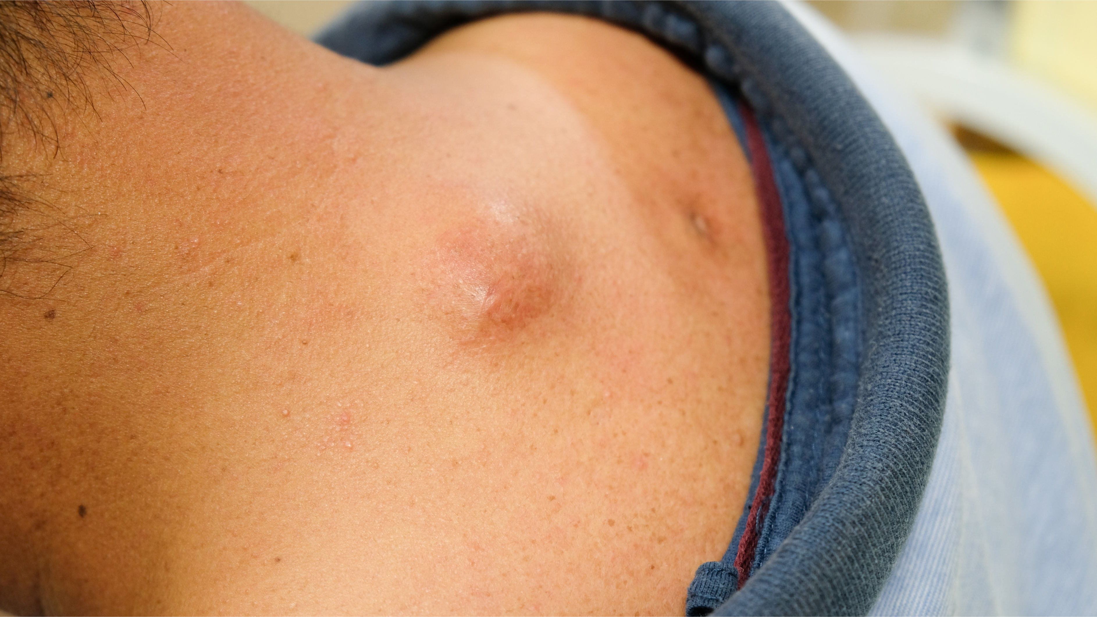 Cysts Craig Singer Md Dermatology