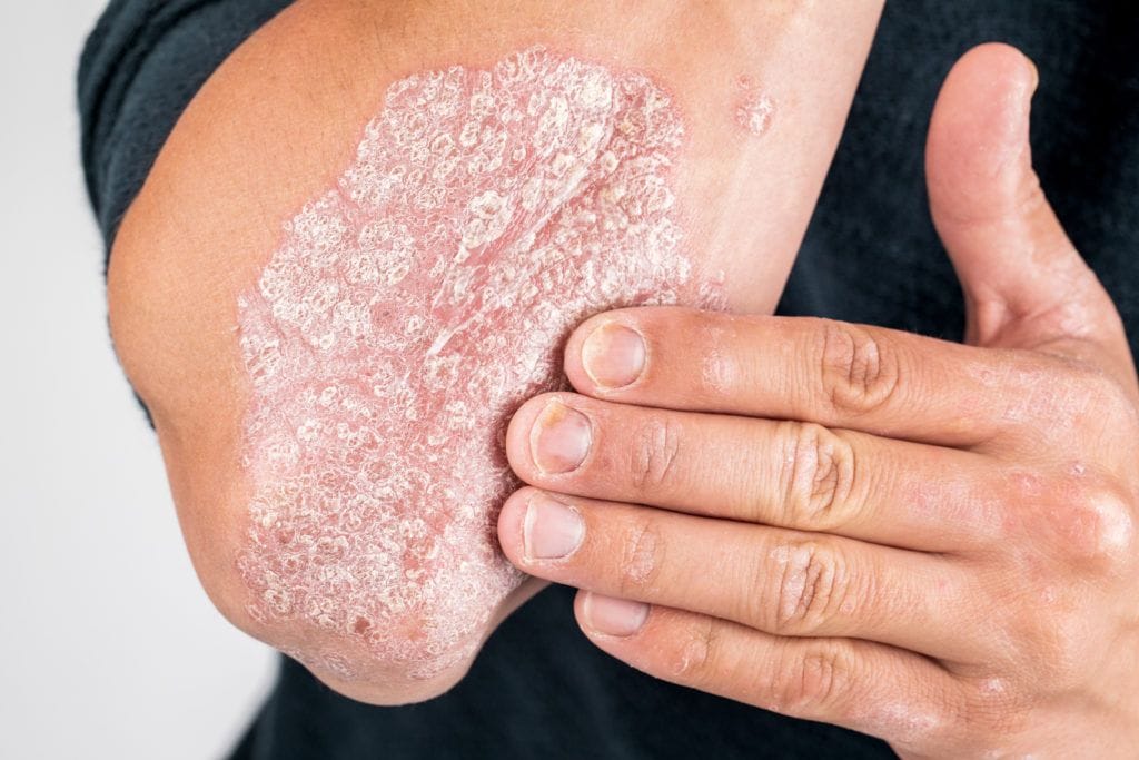 psoriasis scaled