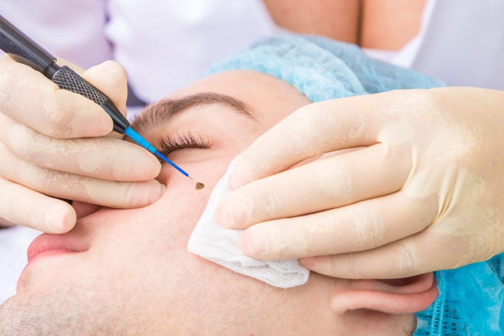 Craig Singer Derm _ Subcision – TFJCFZ