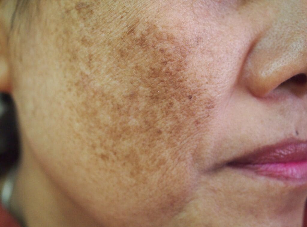 Melasma causing dark brown patches on the cheek and face