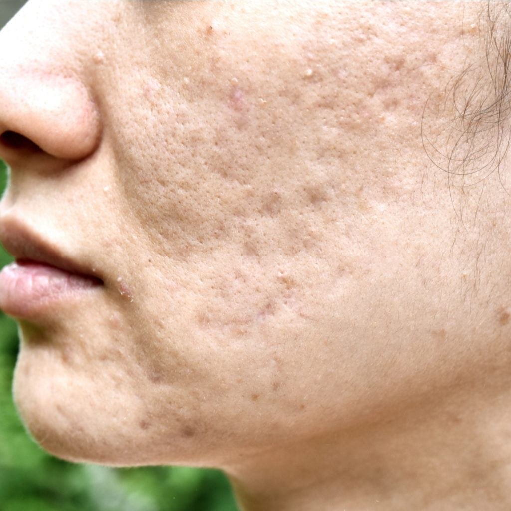 Subcision for depressed acne scars