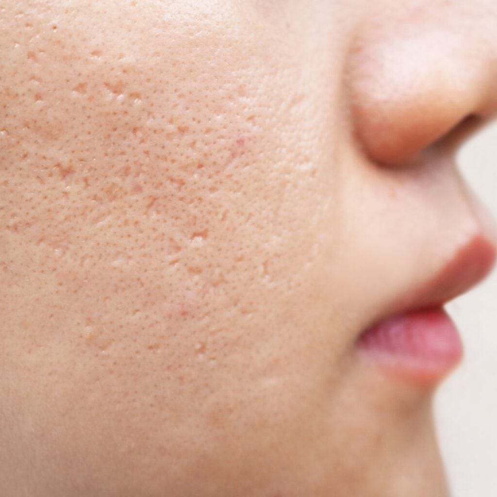 TCA CROSS peel for icepick acne scars